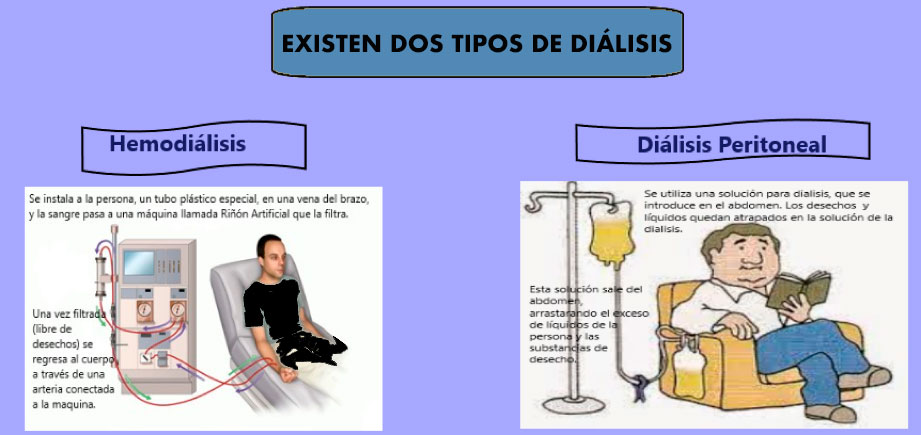 Cuanto Tiempo Vive Una Persona Con Insuficiencia Renal Sin Diálisis